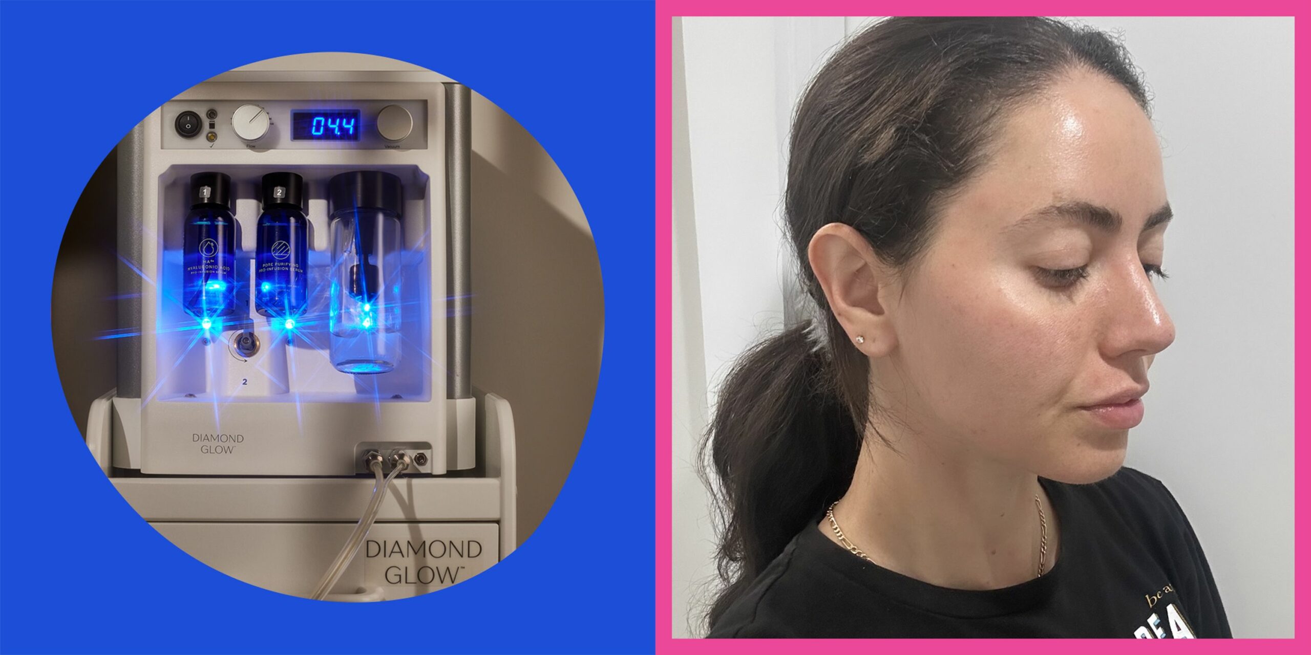 This Game-Changing Facial Transformed My Acne-Prone Skin Overnight—Here’s What No One Tells You About DiamondGlow
