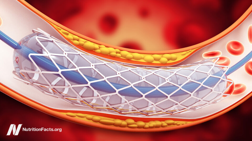 The Shocking Truth Behind Stents: Why They Might Be Doing More Harm Than Good