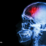 Unlock the Hidden Power of Fasting and Plant-Based Diets: The Surprising Remedy for Migraines and Traumatic Brain Injuries You’ve Never Heard Of