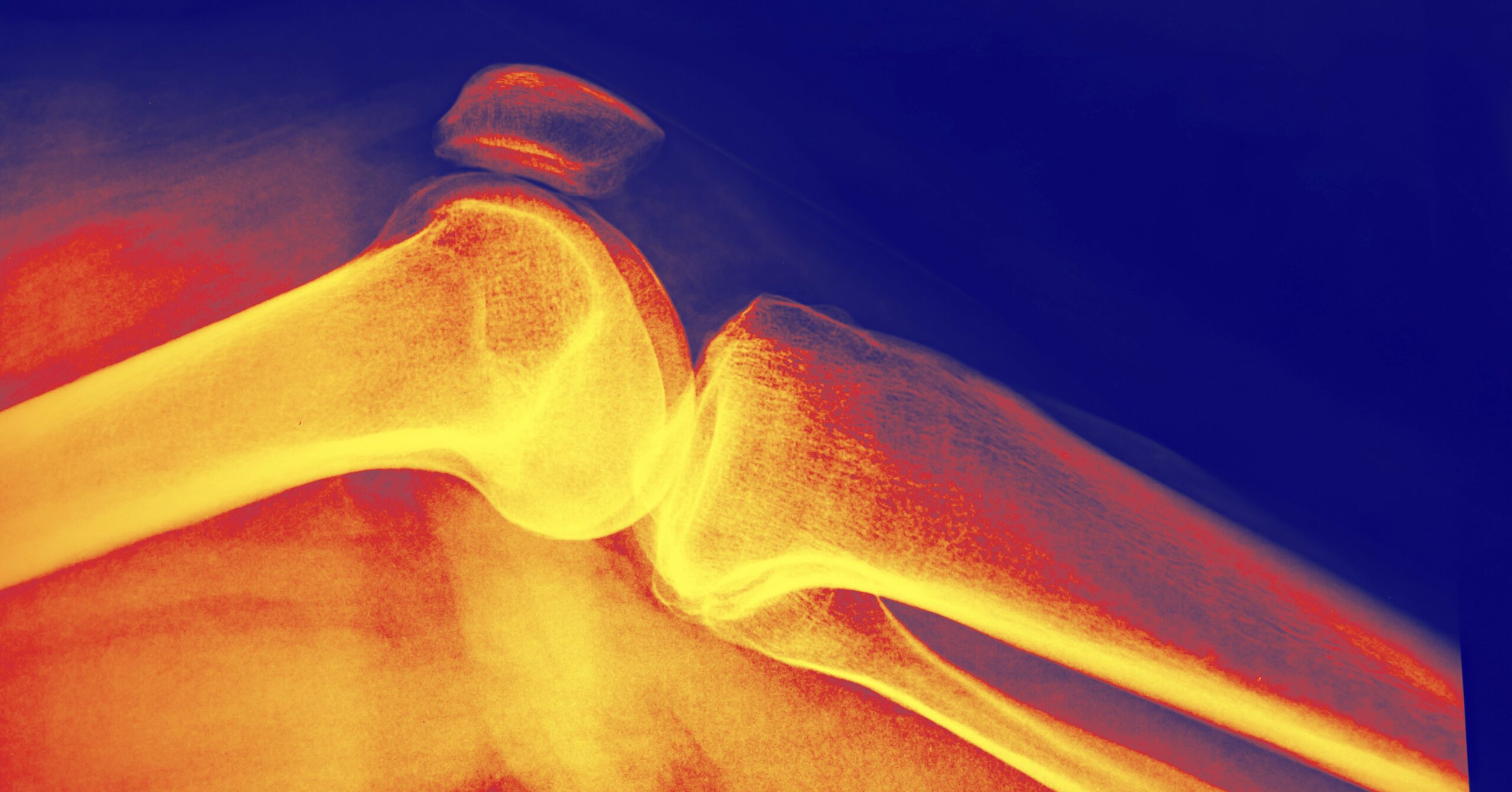 Unlock the Truth: How Quickly Can You Actually Build Bone Density and Crush Weakness for Good?