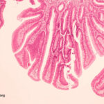 Is Bovine Leukemia Virus the Hidden Trigger Behind Rising Breast Cancer Rates?