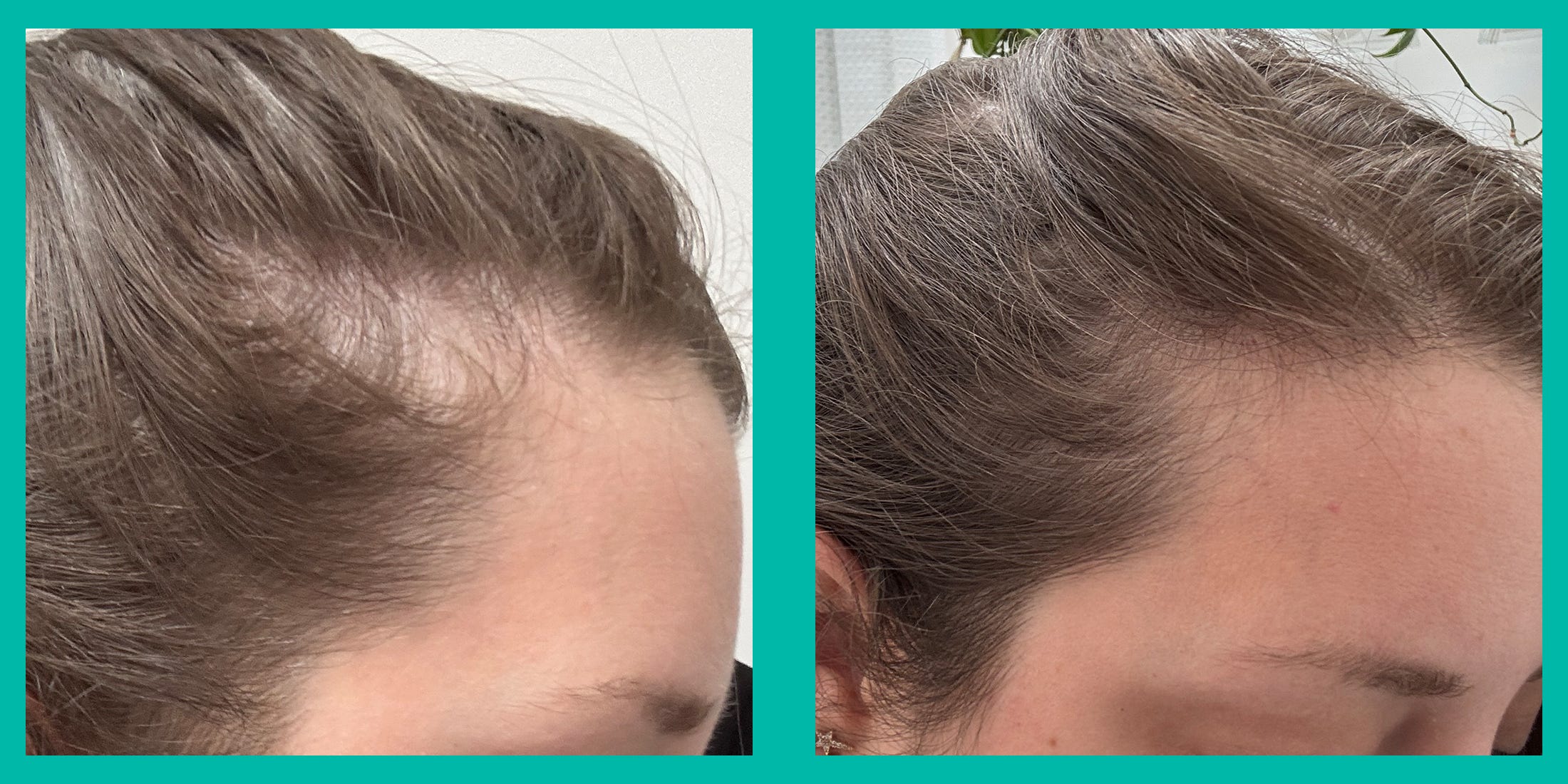 Unlock the Secret Weapon Against Stress and Hormone Hair Loss—Here’s What Happened When I Took These Capsules for 8 Weeks!