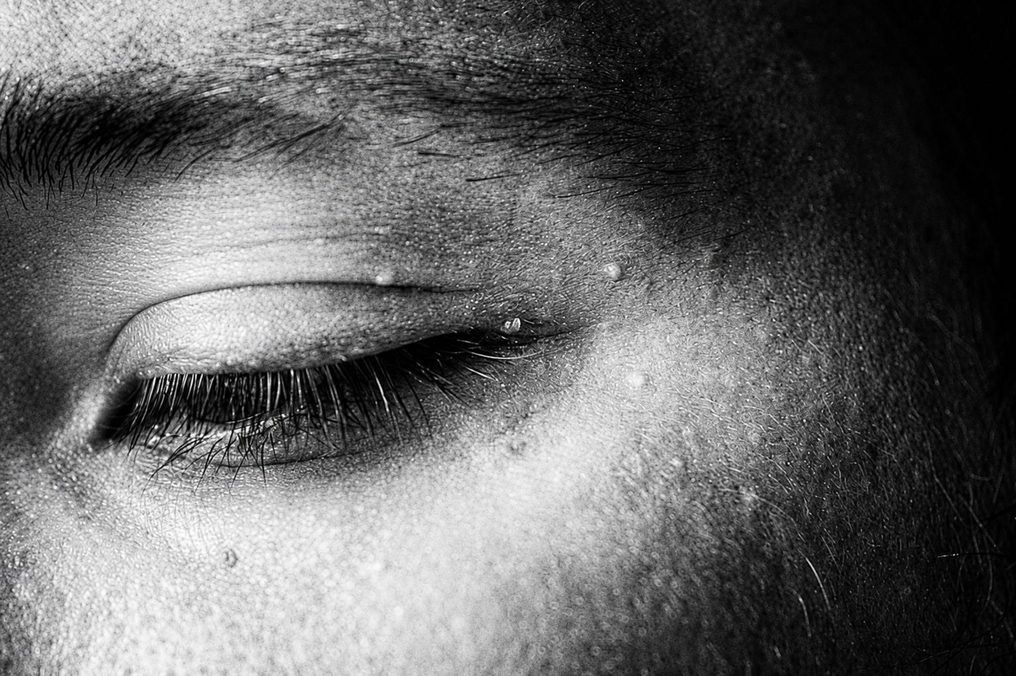 Unlock the Secret Dermatologists Don’t Want You to Know: 4 Killer Hacks to Banish Milia for Good!