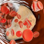 The One Surprising Test Cardiologists Swear By to Reveal Your True Cholesterol Risk—Are You Missing It?