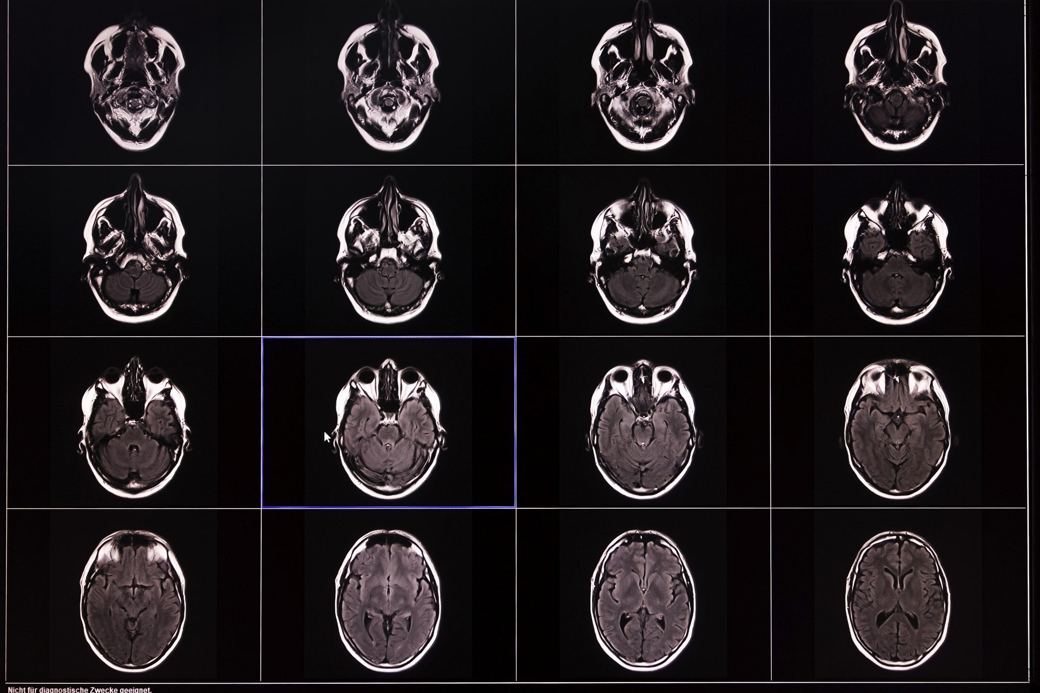 This Groundbreaking Brain Scan Study Flips Everything We Thought About Memory Loss on Its Head – You’ve Got to See This!
