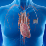 Unlocking Life’s Beat: How a Pacemaker Transformed More Than Just My Heart