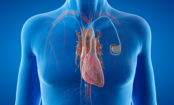 Unlocking Life’s Beat: How a Pacemaker Transformed More Than Just My Heart