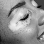 Unlocking the Vitiligo Cure: This Unexpected Therapy Is Changing Lives – Here’s What You Need to Know!