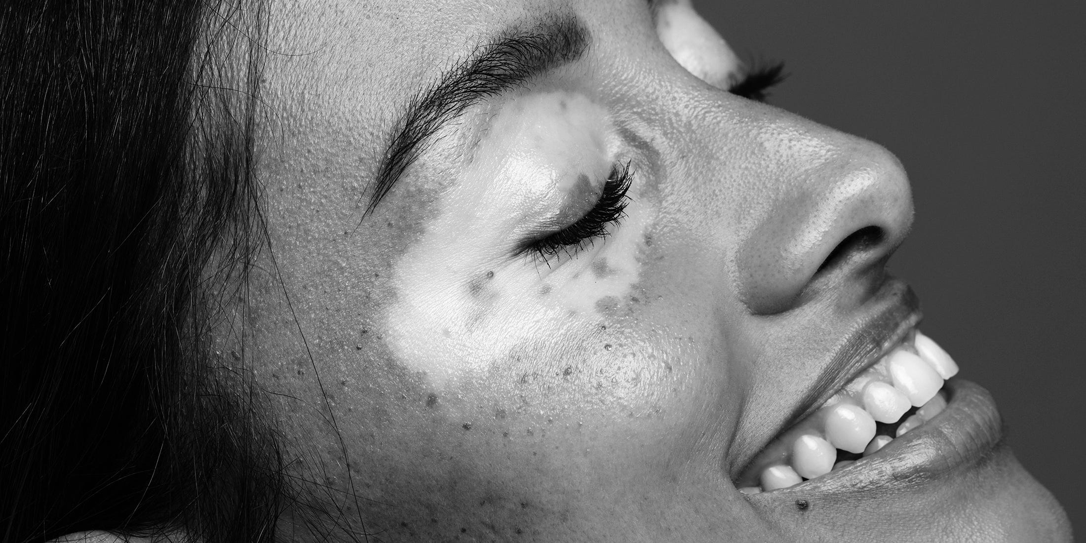 Unlocking the Vitiligo Cure: This Unexpected Therapy Is Changing Lives – Here’s What You Need to Know!