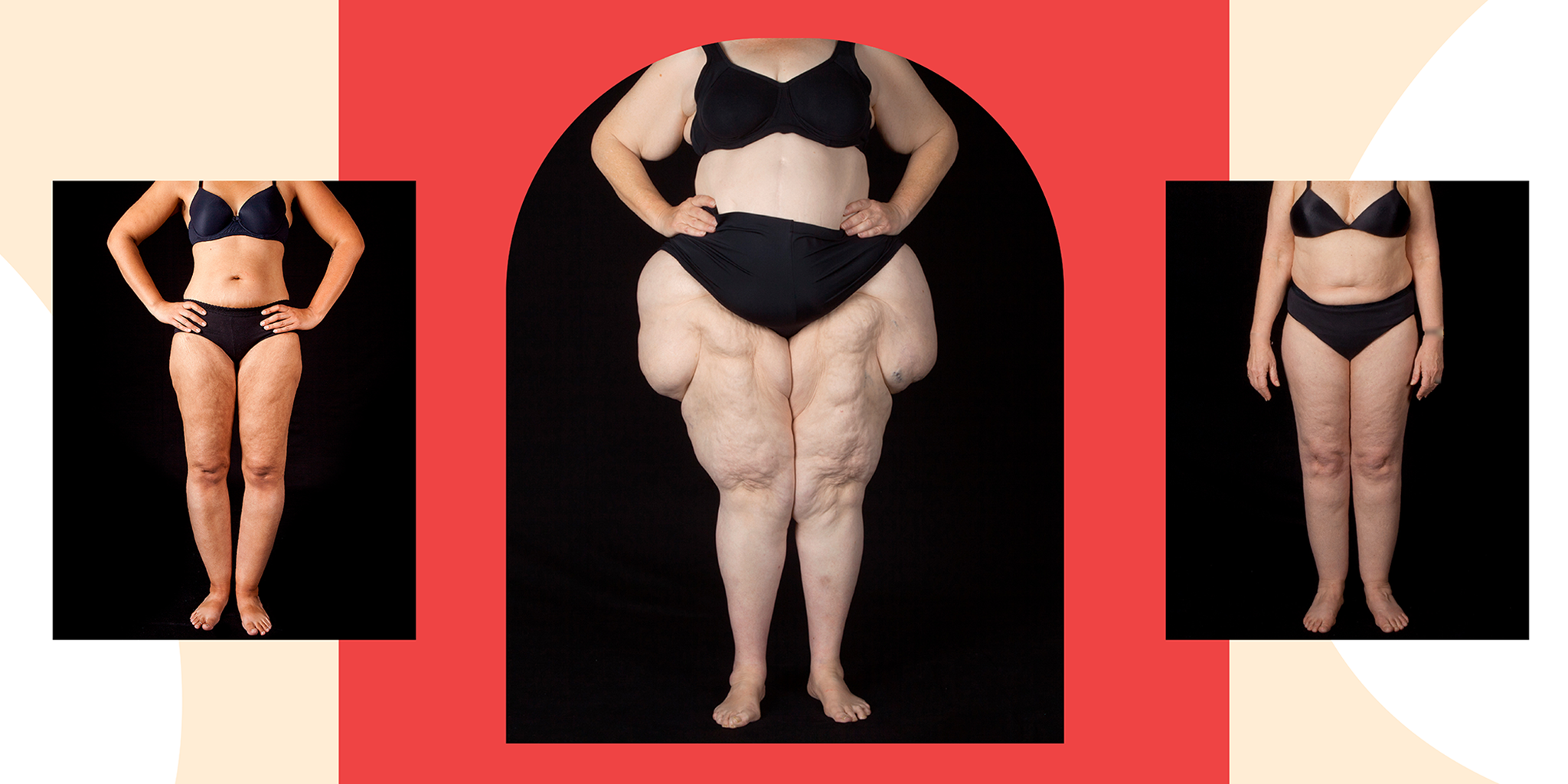 Discover the Shocking Painful Condition Affecting Millions of Women—Why No One’s Talking About It!